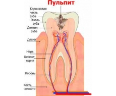 Пульпит